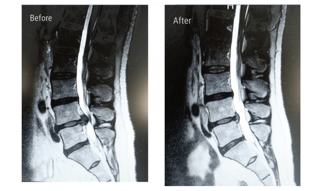 Suffering From a Herniated Disc? - Huffman Spine Clinic - Lumbar
