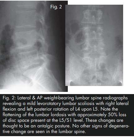 DRX9000 Yochum Study Research True Spinal Decompression