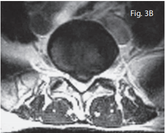 The DRS Protocol™ For Spinal Stenosis - Auth Chiropractic and Vitality