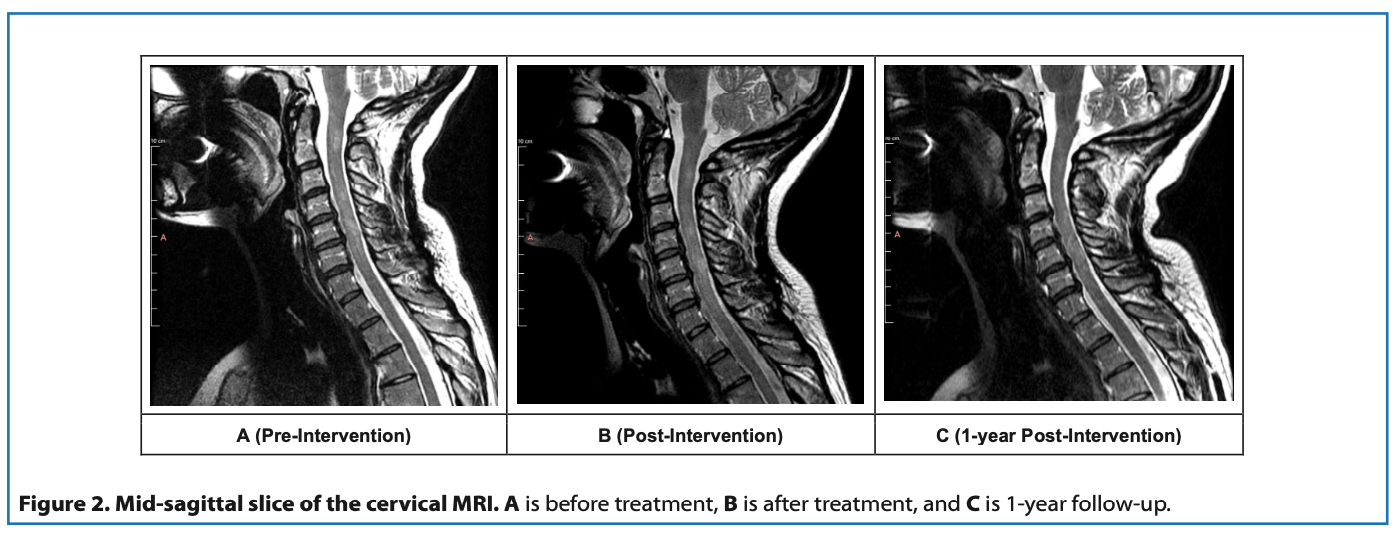 usf cervical study figure mri