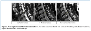 usf cervical study figure mri