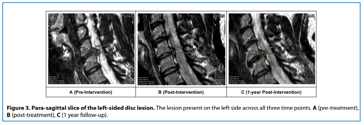 usf cervical study figure mri