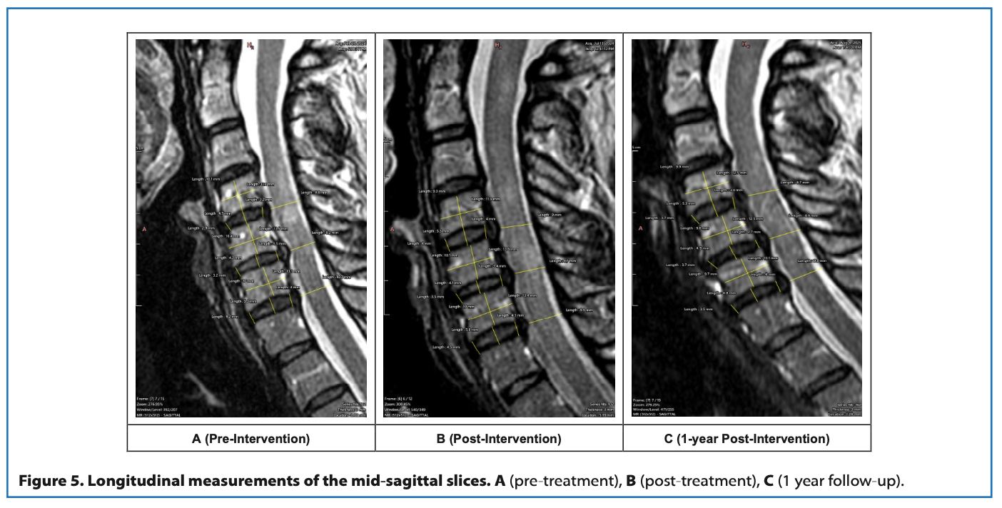 usf cervical study figure mri